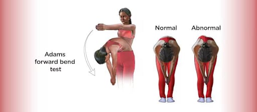 Scoliosis - كيف يُجرى اختبار آدم للكشف عن اعوجاج العمود الفقري؟
