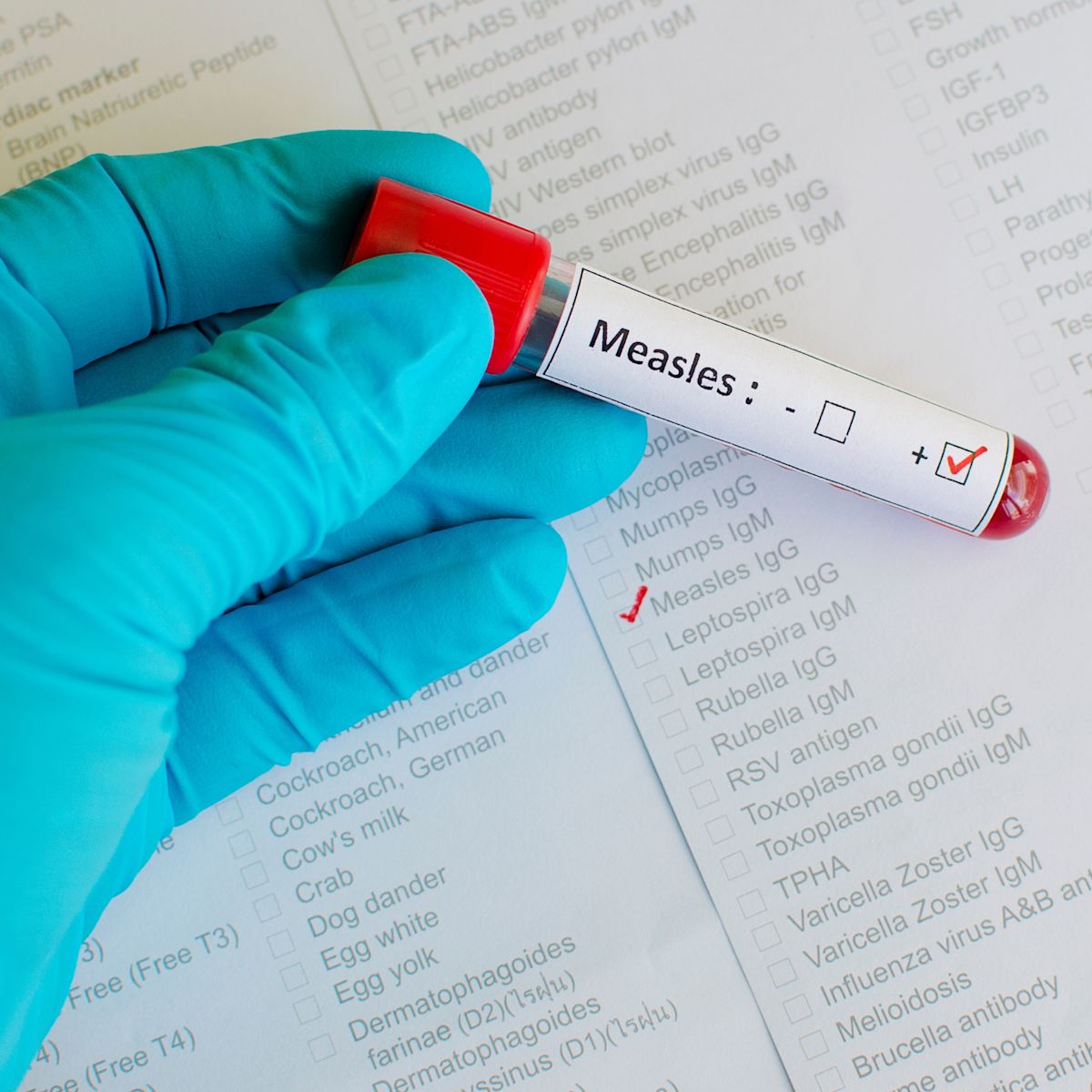 Local measles concerns: facts